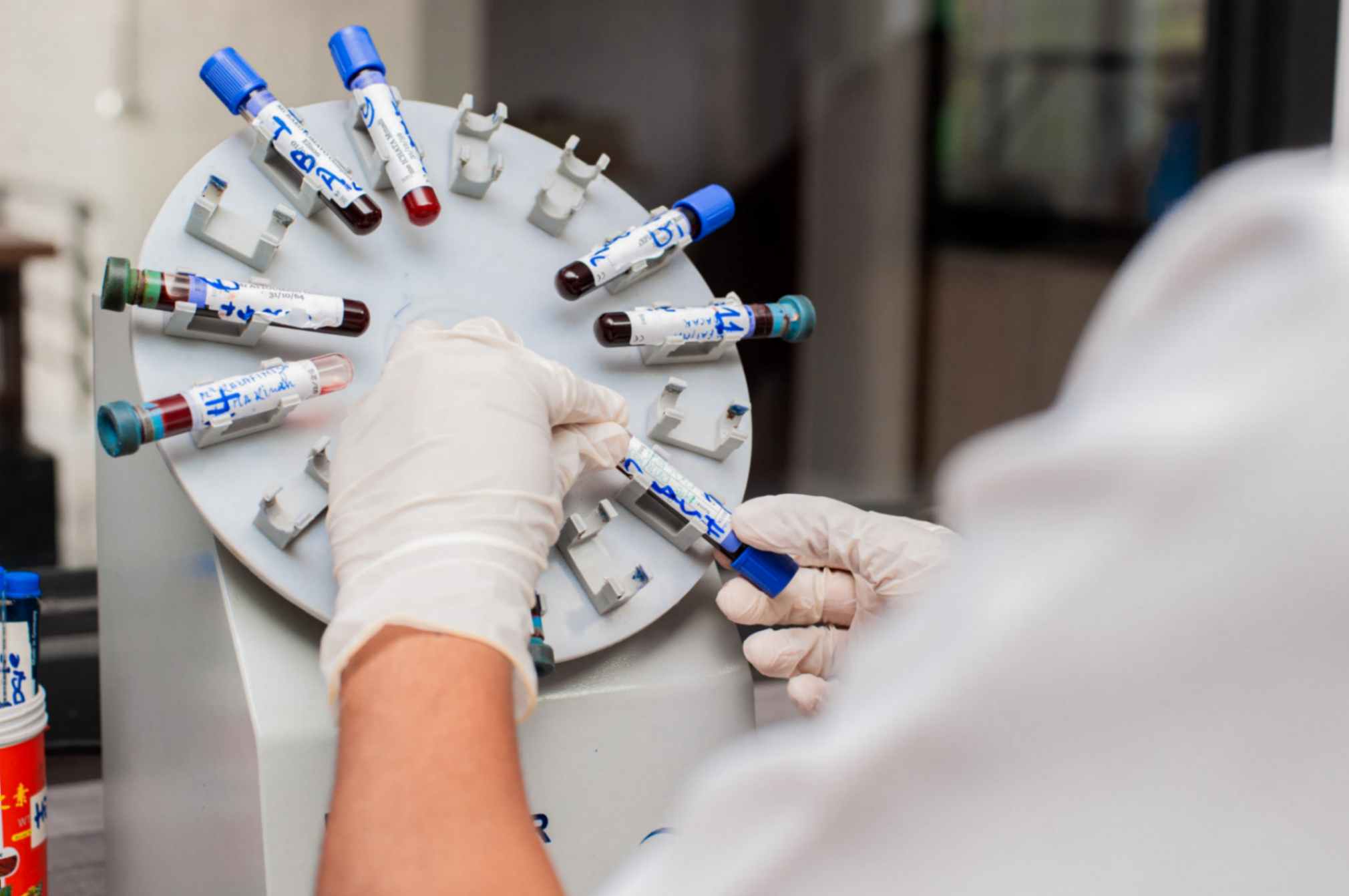 Préparation de plasma riche en plaquettes. Tube avec du sang dans les mains.